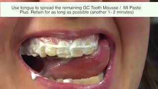 2 Methods to Use GC Tooth Mousse I Tooth Mousse Plus I MI Paste [upl. by Singhal]