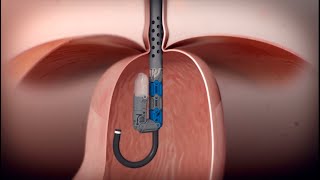 Incisionless Reflux Surgery  EsophyX Transoral Incisionless Fundoplication TIF Procedure [upl. by Gotthelf645]