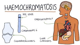 Understanding Haemochromatosis [upl. by Dodds253]