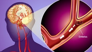 Stroke Prevention amp Transient Ischemic Attack TIA [upl. by Cox]