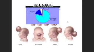 Pediatría  Defectos del Tubo Neural  Mielocele y Meningocele 11 [upl. by Terencio]