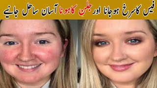 Fece Redness treatment at homechehre ki Redness khatam karne ke 2Asan tarike [upl. by Rebmit808]