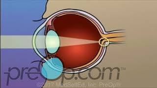 PRK LASIK SMILE Whats the Difference [upl. by Niarb]