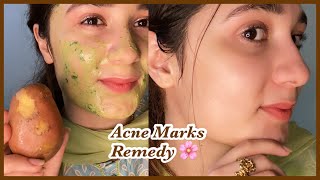 7 days Challenge  Remove Acne scars  Marks  soft and healthy Skin [upl. by Sirap]