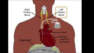 Left Phrenic Nerve Anatomy Relative to the Coronary Venous System [upl. by Ilarin]