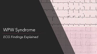 WolffParkinsonWhite WPW Syndrome ECG [upl. by Salene]