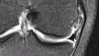 Medial collateral ligament anatomy on MRI [upl. by Eerot]