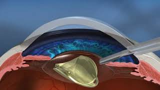 Cataract Intraocular implants compared PanOptix versus Vivity [upl. by Nepets]