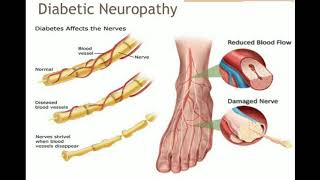 Senam Kaki Kaki Diabetes [upl. by Neeham]