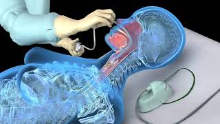 Nasotracheal suctioning NTS  3D animation [upl. by Sansone120]