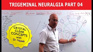 Trigeminal Neuralgia  Causes and Treatment  Part 4 [upl. by Melony]