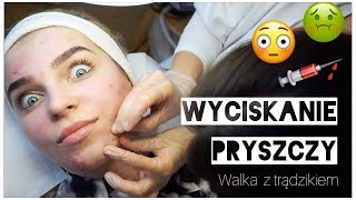 WYCISKANIE PRYSZCZY 😱💉 walka z trądzikiem 💪 [upl. by Nolubez]