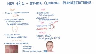 HSV  Clinical Presentation  Part 2 [upl. by Duma]