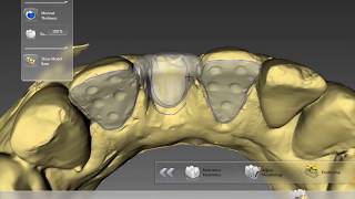 Digital Maryland bridge  Inlab Dentsply Sirona CAD CAM [upl. by Moneta]