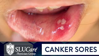 What causes mouth ulcers Experts explain [upl. by Enilada]