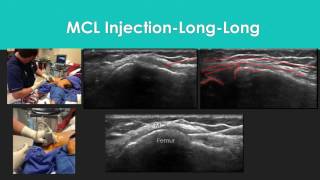 Knee Level 2 MCL Under Ultrasound [upl. by Gallager38]