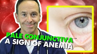 Pale Conjunctiva  A Sign of Anemia [upl. by Nedla]