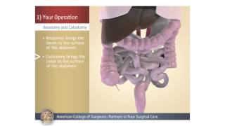 ColostomyIleostomy Your Operation [upl. by Nolyd]