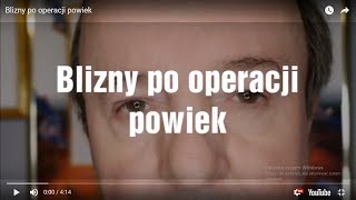 Blizny po operacji powiek [upl. by Eugilegna321]