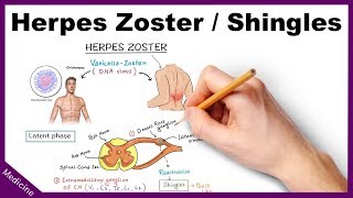 Herpes ZosterShingles Symptoms Diagnosis Treatment [upl. by Ettenaej41]