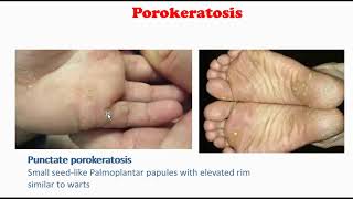 Porokeratosis [upl. by Rabka752]