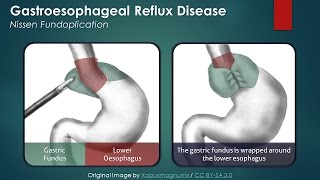 Gastroesophageal Reflux Disease GERD Nissen Fundoplication [upl. by Coppola997]