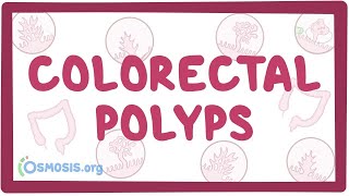 Colorectal polyps  an Osmosis Preview [upl. by Ivy793]