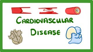 GCSE Biology  Why Do We Get Heart Disease and How to Treat It  Cardiovascular Disease CVD 47 [upl. by Atinit]