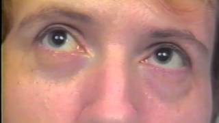 Does Strabismus Cause Nystagmus [upl. by Dodge]