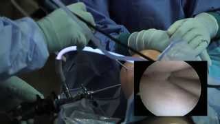 Recovery and Expectations  Arthroscopy [upl. by Ennaeirb194]