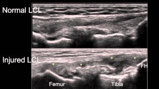 Sonographic Examination of Knee Ligaments [upl. by Del]