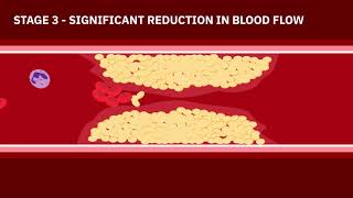 Coronary Artery Disease Animation [upl. by Modla290]