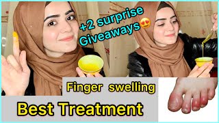 How To Treat Swollen Fingers At Home  Chilblains  Fingers Swelling in Winters  Dietitian Aqsa [upl. by Celia]