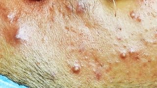 Extraction dacné kystique et pustule  cystic acne [upl. by Ydnerb3]