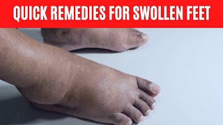 Home Remedies for Swollen Feet  Edema Remedy [upl. by Lrig]