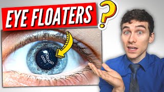 3 Must Know Facts About EYE Floaters [upl. by Vitek]