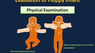 The Floppy Infant Hypotonia [upl. by Mart]