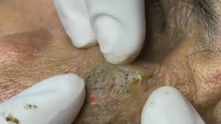 Tirando cravos gigantes cravos pretos removing big blackheads Terapia para relaxarCurta o Vídeo [upl. by Dita845]