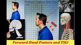 TMJ amp Forward Head Posture [upl. by Laehpar971]