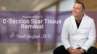 CSection Scar Tissue Removal  Procedure Part 5  David Ghozland MD [upl. by Sylvester74]