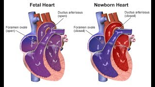 ¿Qué son las cardiopatías congénitas [upl. by Brost]