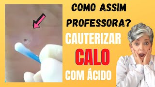 Cauterizar Calo com Ácido Como Assim Professora [upl. by Kevina557]