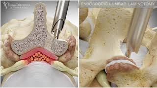 Endoscopic Lumbar Laminotomy  Spine Institute of North America [upl. by Schick]