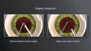 ‘Botched’ Cataract Surgery Edition Posterior Capsule Rupture Explained [upl. by Cassandre25]