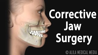 Corrective Jaw Orthognathic Surgery Animation [upl. by Diandre735]