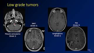 Imaging brain tumors  4  Other low grade gliomas [upl. by Neillij]