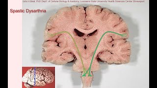 Spastic Diplegic Cerebral Palsy  Quick Look [upl. by Shanney]