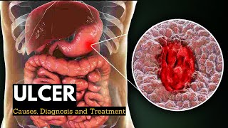 Aphthous ulcer stomatitis Canker sore treatment [upl. by Chatwin462]