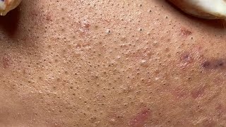 Satisfying Hien Spa Beauty Relaxing Video 28 [upl. by Pall]