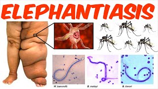 Lymphatic Filariasis  Elephantiasis [upl. by Ettenav]